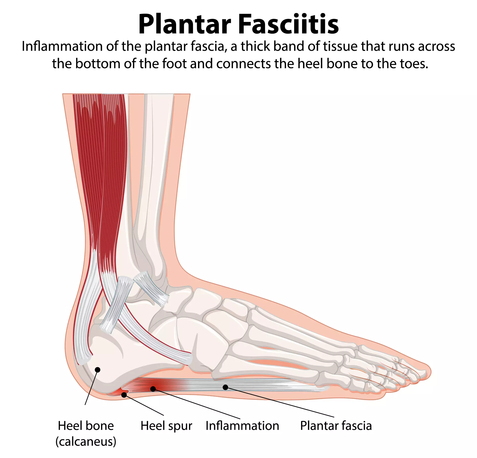 Plantar Fasciitis  Jersey City, NJ 