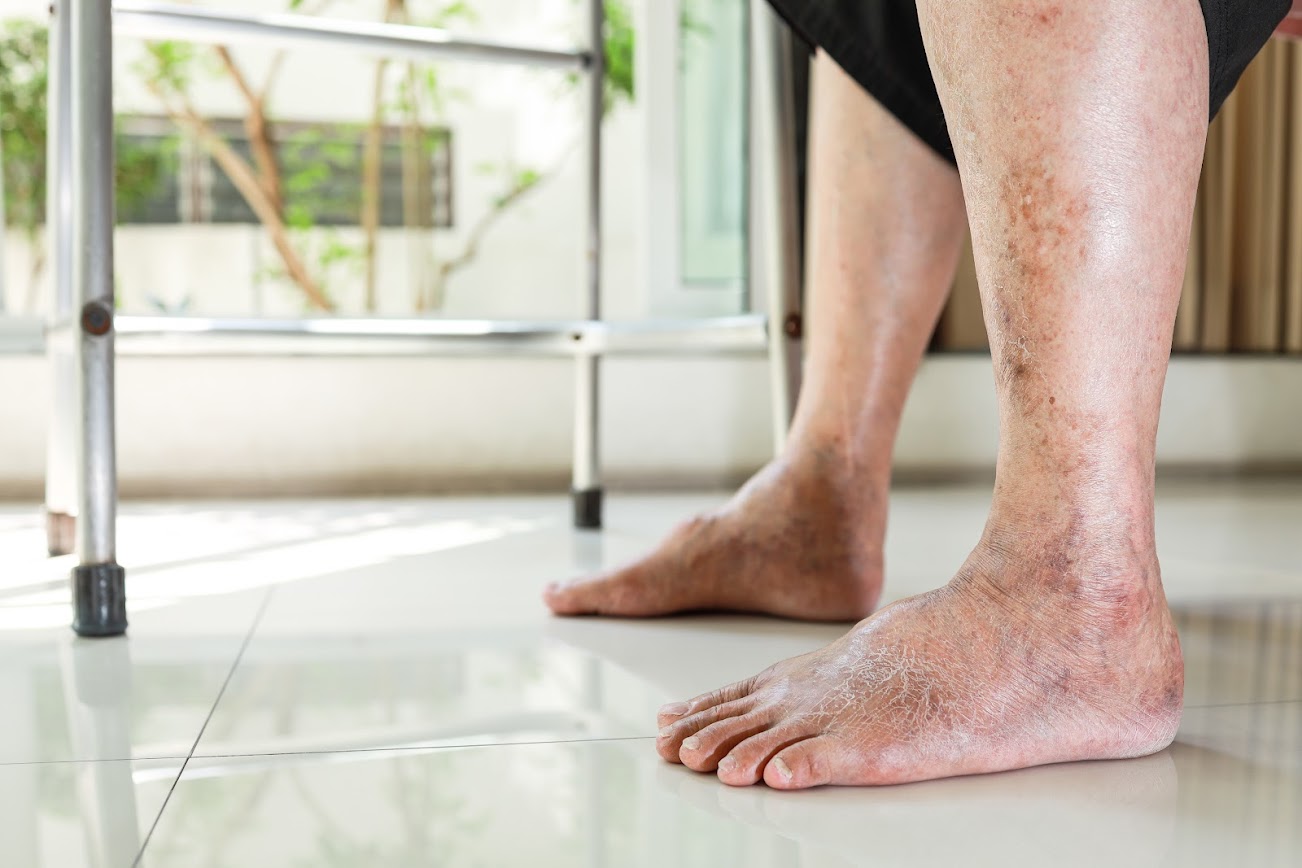 Diabetic foot examination and preventive podiatry care