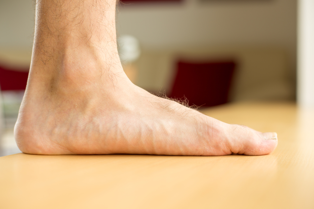 Flat feet causing arch pain and altered walking mechanics