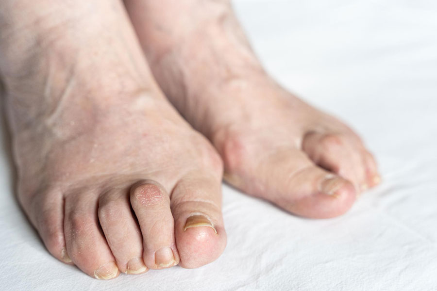 Bunion Treatment Jersey City